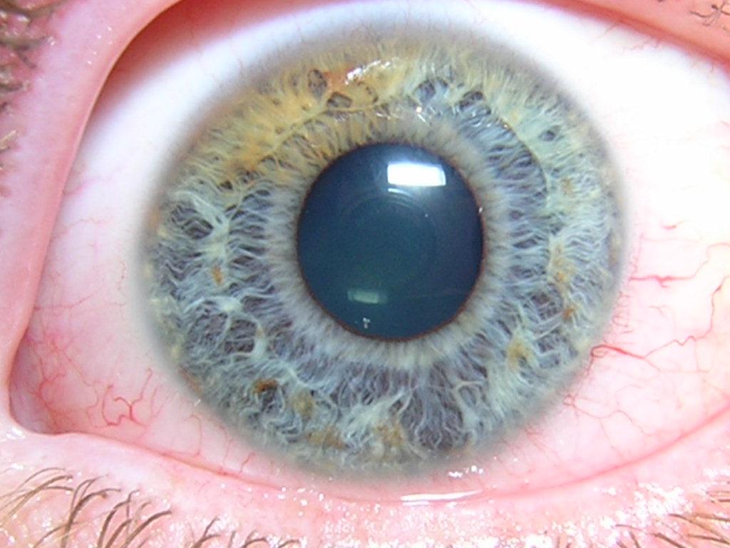 Глазное давление при катаракте. Неоваскулярная глаукома.